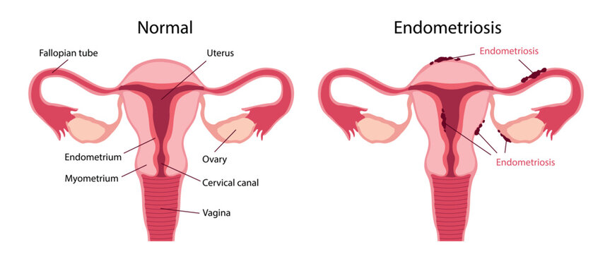 Endometriosis. Comparison diagram showing a normal uterus and endometriosis. The normal uterus illustration includes labels for the fallopian tube, uterus, ovary, endometrium, myometrium, cervical can