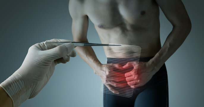 Surgeons use surgical mesh to treat hernias.