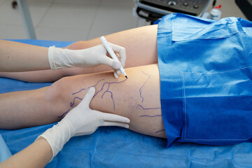 Vascular specialist marking veins on legs before treatment.