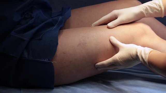 4k video Vascular leg examination as a doctor visually inspects and palpates the thigh to evaluate vein patterns.