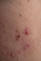 Fototapeta premium Acne and pimple,on skin closeup. Acne macro, pimple on skin. Pimple texture in pores. Pimple macro for dermatology.
