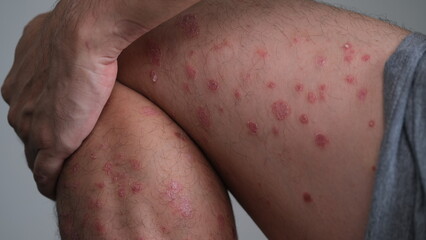 Fototapeta premium The early signs of redness on the skin that then dries and flare up to become Psoriasis Guttate on leg.
