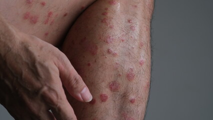 The early signs of redness on the skin that then dries and flare up to become Psoriasis Guttate on leg.