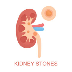 Vector illustration of a human kidney with stones isolated on white background. Clear visual concept of kidney problems, pain, discomfort, urology issues, health warning, disease awareness