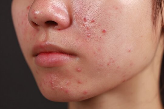 Close-up of a young person's cheek with acne and blemishes, showing skin texture