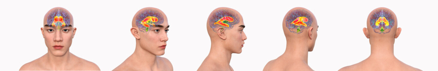 Enlarged lateral ventricles, 3D illustration