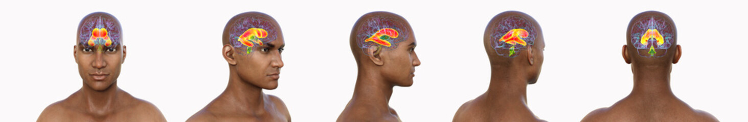 Enlarged lateral ventricles, 3D illustration