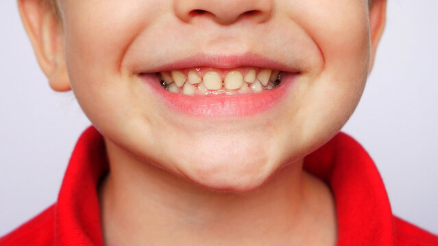 Close-up of a smiling boy's baby teeth