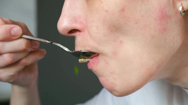 Close up side view young woman with problematic skin eating asian soup with noodles, wakame seaweed, shiitake mushrooms from a spoon, enjoying delicious. Person with acne eating asian udon noodle soup
