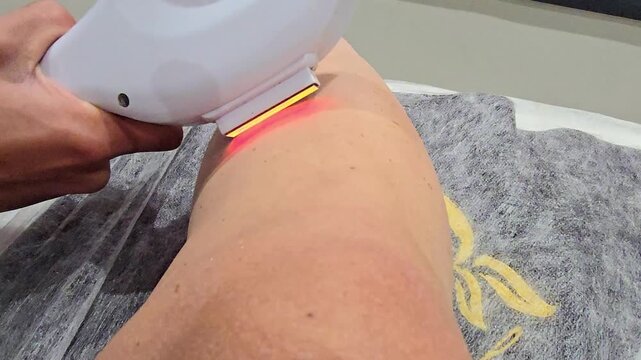 Performing a treatment with a device at a laser hair removal clinic