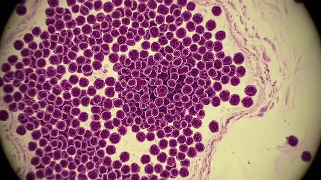 Microscopic view of malignant cells showing abnormal uncontrolled cellular division and rapid cancer tumor proliferation for scientific study