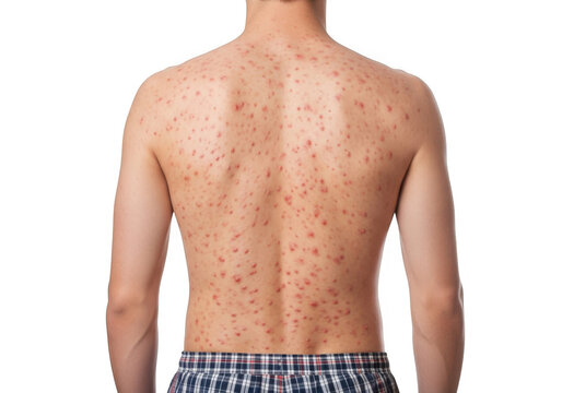 Back of a young man covered in numerous red acne pimples and skin rash spots, isolated on transparent background
