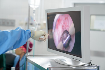 Transurethral Resection of the Prostate