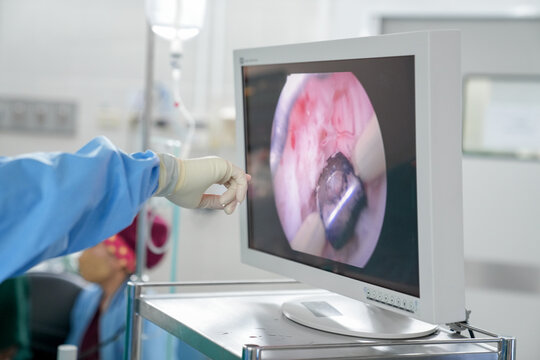 Transurethral Resection of the Prostate
