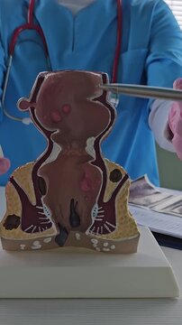Anatomical model of rectum with hemorrhoids in clinic concept