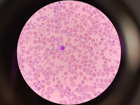 Microscopic view of thrombocytosis with a giant platelet (macrothrombocyte) in a peripheral blood smear 