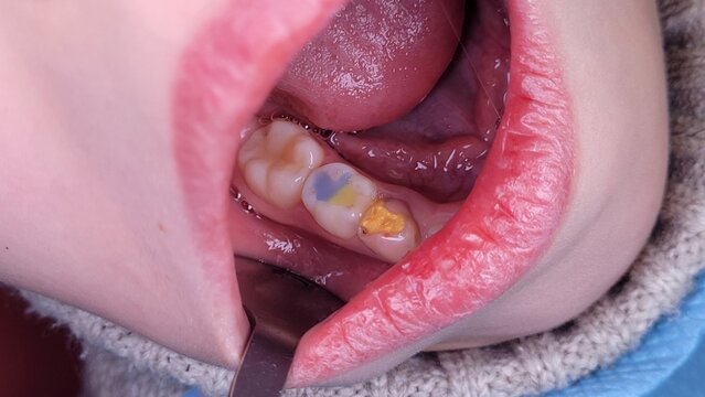 Child's primary molar tooth with blue sealants