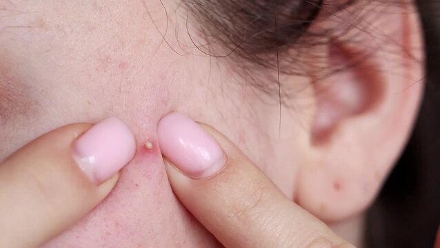 Close-up video of a young woman touching skin near a pimple on her face. Acne problem, skincare routine, dermatology, skin imperfection, beauty treatment, facial care concept, real skin texture.