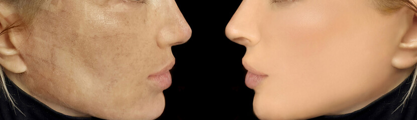 Obraz premium CO2 laser treatment ,Cosmetic Laser Dermatology 