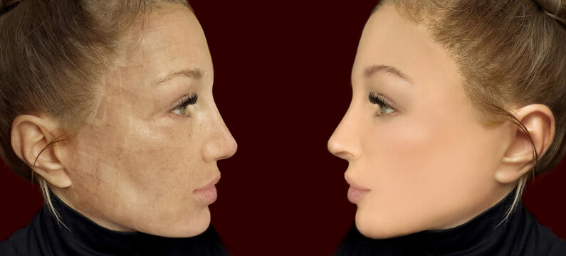 CO2 laser treatment ,Cosmetic Laser Dermatology 