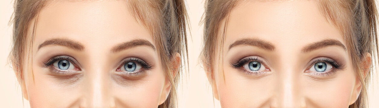 Lower and upper Blepharoplasty.Marking the face.Perforation lines on females face, plastic surgery concept.