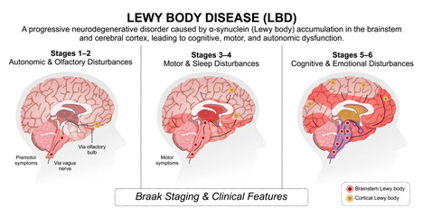 Lewy Body Disease (LBD) Medical Flashcard