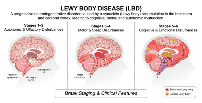 Lewy Body Disease (LBD) Medical Flashcard