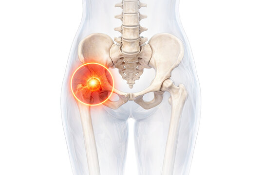 Human hip joint pain anatomy highlighting pelvis femur inflammation bones orthopedic medical illustration isolated on white background