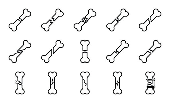 Broken bone fracture icon set showing various trauma types and surgical repair on transparent background