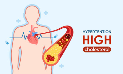 Illustration illustrating unhealthy Coronary conditions with high cholesterol.