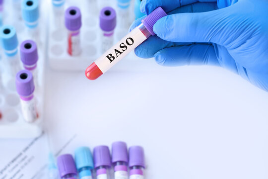 Doctor holding blood sample tube with BASO test in medical laboratory, basophil blood analysis for allergy, inflammation and immune system diagnostics, healthcare concept, copy space