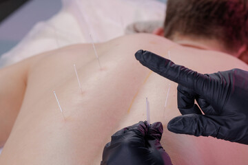 Dry Needling Acupuncture Therapy on Male Back During Clinical Session
