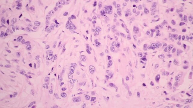 Backgrounds of human cells tissue of lung under the microscope in pathology lab.View in microscopic of adenocarcinoma from human cervical cancer.The malignant breast cells tissue section by H and E.