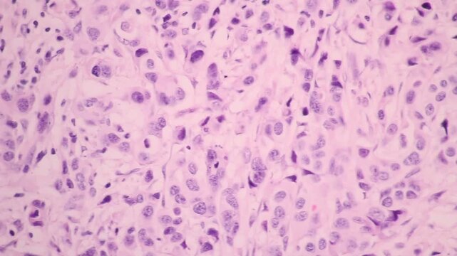 Backgrounds of human cells tissue of lung under the microscope in pathology lab.View in microscopic of adenocarcinoma from human cervical cancer.The malignant breast cells tissue section by H and E.