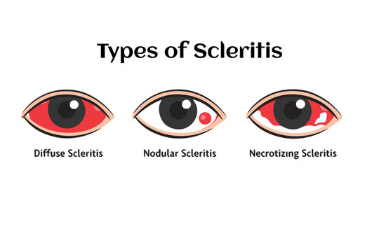 Diffuse Nodular Necrotizing Scleritis Types 2D Flat Infographic