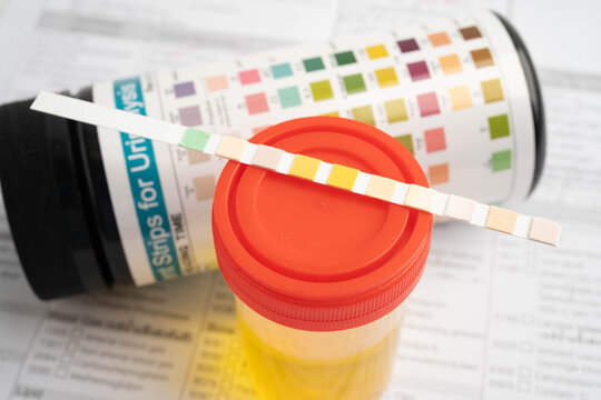 Urinalysis, urine cup with reagent strip pH paper test and comparison chart in laboratory.