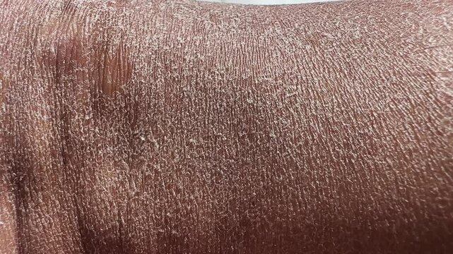 Concept of extremely dry and dehydrated skin of the body. Problematic skin diagnosed with xerosi or dermatitis. Close up of chapped arms and legs. Selective focus of a itchy skin