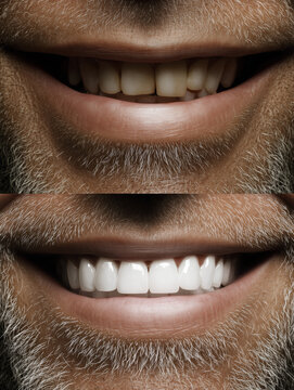 Dientes de hombre con barba antes y despu&eacute;s, Banner web para cl&iacute;nica dental marketing de servicios, Mockup sonrisa perfecta para publicidad cl&iacute;nica dental