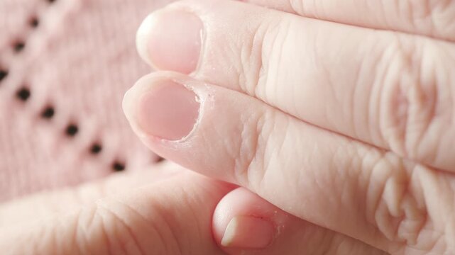 hangnails on fingers, skin scrap, area of ​​exfoliated epidermis surrounding nail, Compulsive nail and cuticle biting, Stress relief or self-harm, obsessive-compulsive disorder, mental health