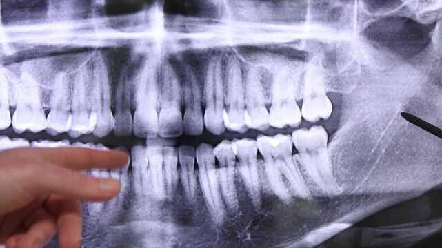 Dentist pointing at panoramic dental x ray for patient consultation