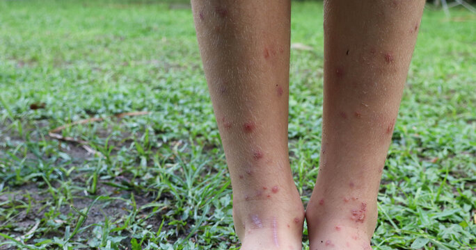 Legs of a child with black fly bites in an Atlantic Forest region.