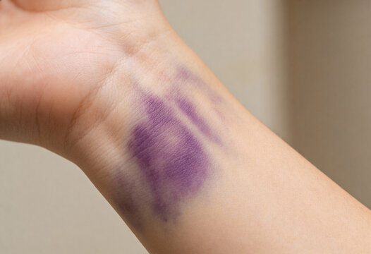 Close-up photo of a large purple and violet bruise on a person's light-toned wrist or forearm.