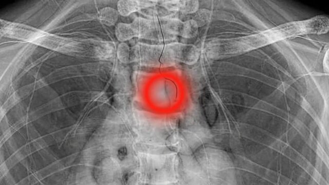Medical Xray Image of Human Chest.