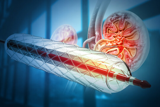 Stent angioplasty. Peripheral artery disease. 3d illustration