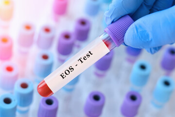 Obraz premium Doctor holding blood sample tube for eos test, laboratory diagnostics of eosinophil levels for allergy detection, parasitic infection screening and immune response evaluation in clinical medicine,