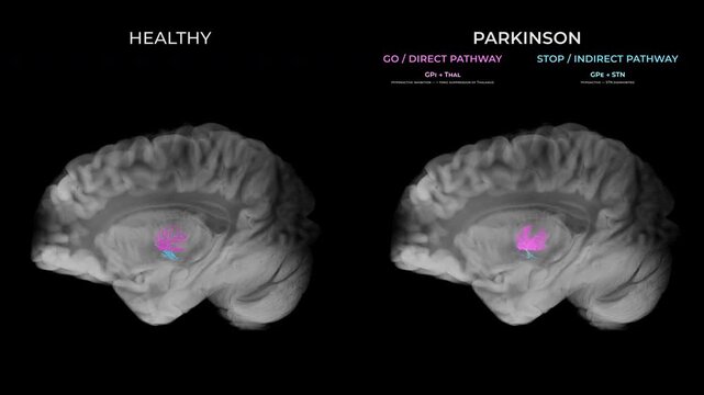 Parkinson Dopamine Loss Basal Ganglia Motor Circuit Comparison