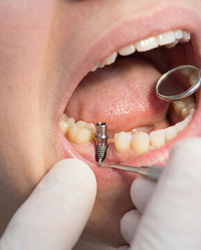 Dental Implant Placement as Replacement for Extracted Wisdom Tooth, Oral Surgery Concept, Close-Up Clinical Visualization, Educational Dentistry and Prosthetic Procedure