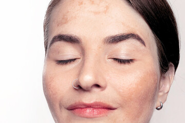 Caucasian woman shows face with pigmentation, melasma, freckles, age spots photo close up