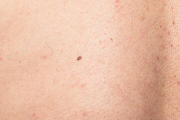 Fototapeta premium Closeup of human skin with mole and slight redness texture