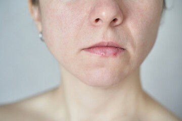 Obraz premium Caucasian female adult with chapped lips and skin texture close-up showing dryness and natural facial features.